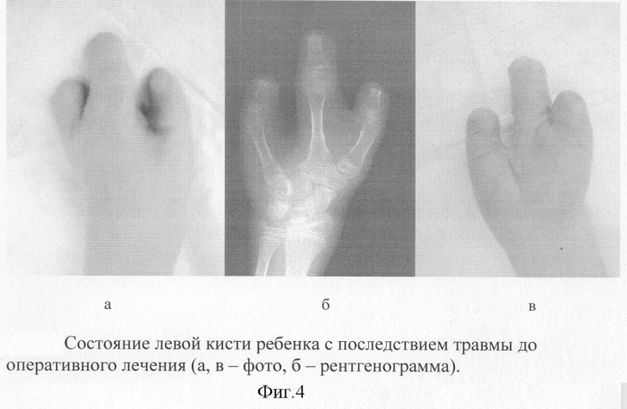 Способ реконструкции пальцев кисти у детей с последствиями травмы (патент 2278630)