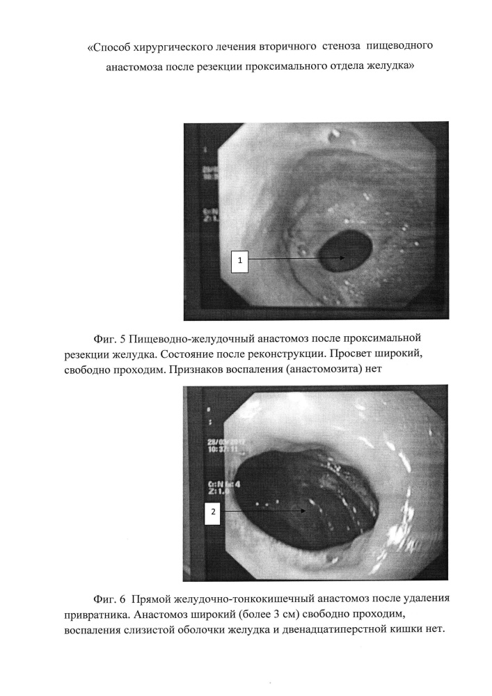 Способ хирургического лечения вторичного стеноза пищеводного анастомоза после резекции проксимального отдела желудка (патент 2657192)