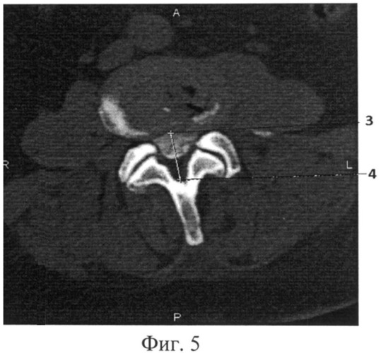 Способ диагностики стенозирующих процессов позвоночного канала и дурального мешка на поясничном уровне (патент 2483675)