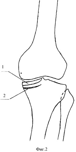 Способ лечения деформирующего артроза коленного сустава (патент 2412667)