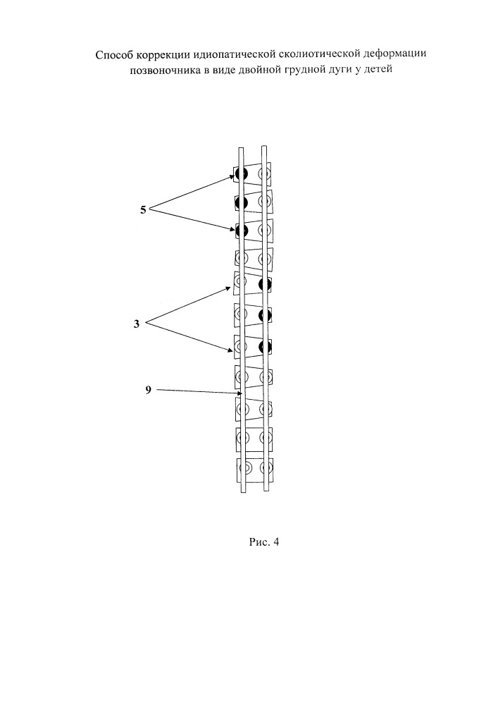 Способ коррекции идиопатической сколиотической деформации позвоночника в виде двойной грудной дуги у детей (патент 2651111)