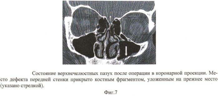 Способ хирургического лечения хронического дакриоцистита (патент 2532014)