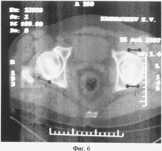 Способ диагностики локальных участков компрессии тазобедренного сустава у больных коксартрозом методом компьютерной томографии (патент 2377954)