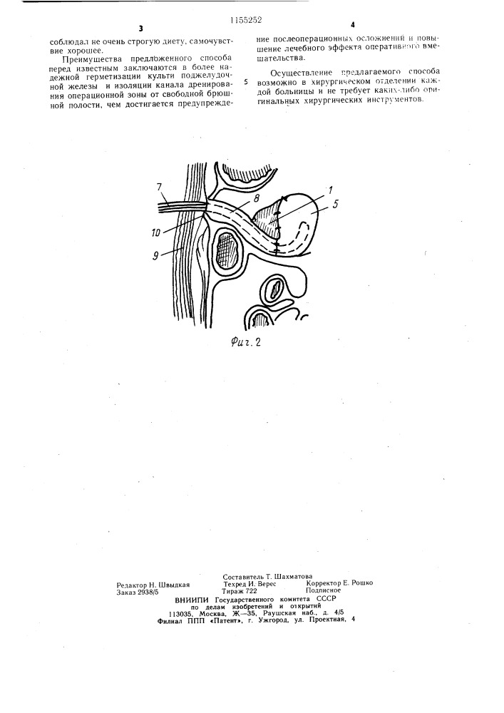 Способ резекции поджелудочной железы (патент 1155252)