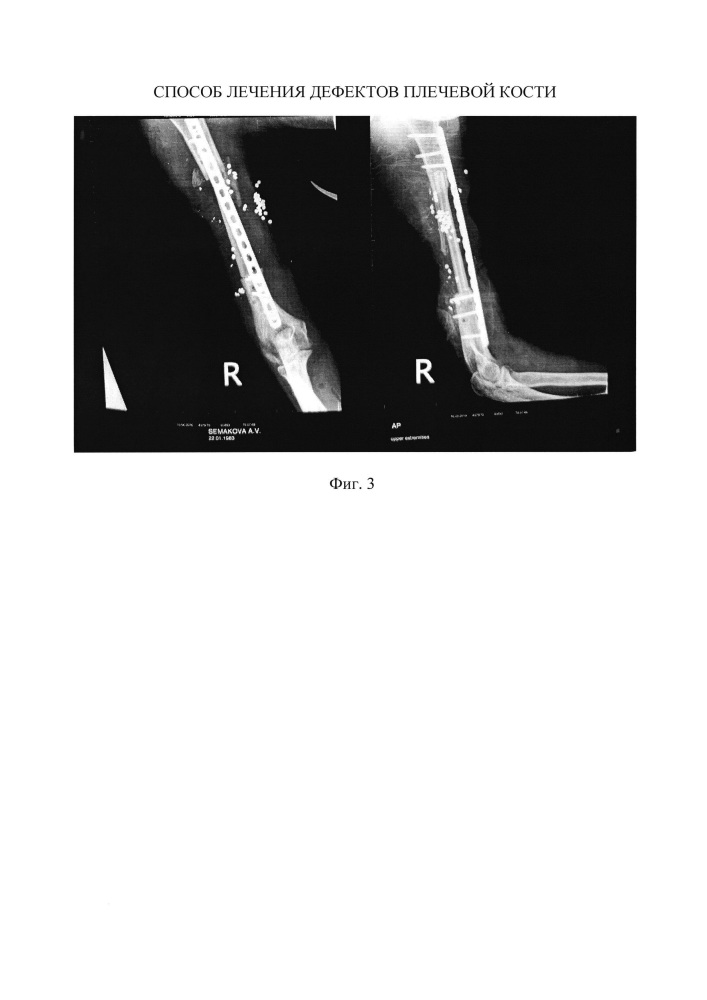 Способ лечения дефектов плечевой кости (патент 2617092)