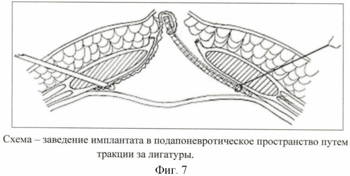 Способ размещения имплантата (патент 2445011)