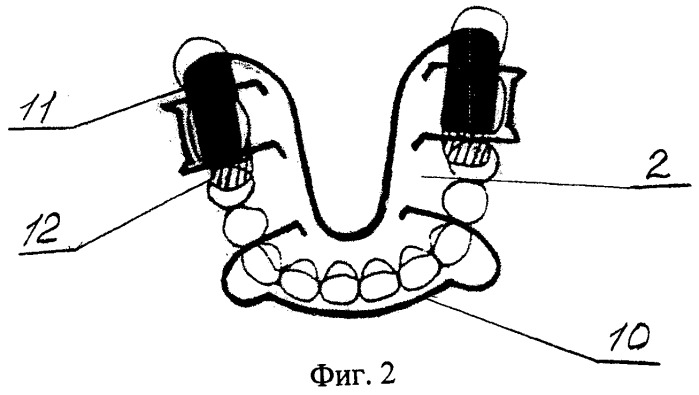 Аппарат для лечения гнатической формы мезиальной окклюзии у подростков (патент 2547794)