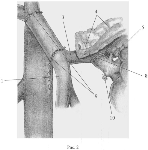 Способ панкреатодуоденальной резекции при местнораспространенном раке периампулярной области с опухолевой инвазией воротной вены (патент 2526918)
