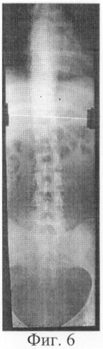 Способ коррекции деформации позвоночного столба (патент 2300400)