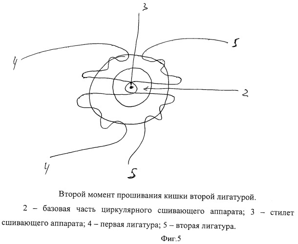 Способ формирования аппаратного колоректального анастомоза (патент 2476160)