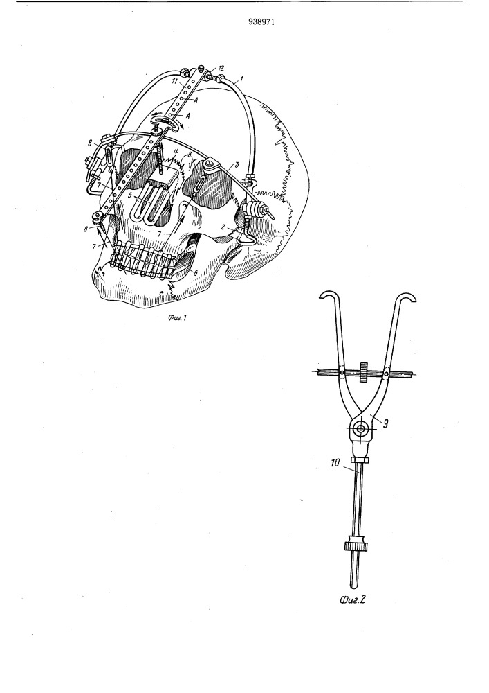 Аппарат для лечения переломов верхней челюсти (патент 938971)