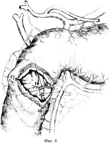 Способ хирургического лечения осложненных низких дуоденальных язв с поражением большого и малого дуоденальных сосочков (патент 2328222)