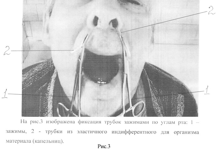 Способ лечения опухолей носоглотки (патент 2520253)