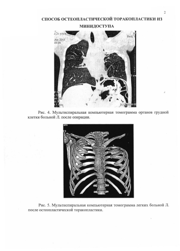 Способ остеопластической торакопластики из минидоступа (патент 2587315)