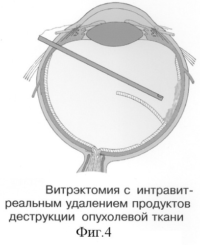 Способ электрохимической деструкции, хирургического удаления и фотодинамической профилактики рецидивов внутриглазных новообразований (варианты) (патент 2244531)