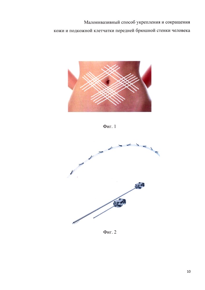 Малоинвазивный способ укрепления и сокращения кожи и подкожной клетчатки передней брюшной стенки человека (патент 2631644)