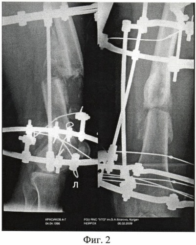 Способ лечения больных с застарелыми, неправильно сросшимися переломами бедренной кости (патент 2445032)