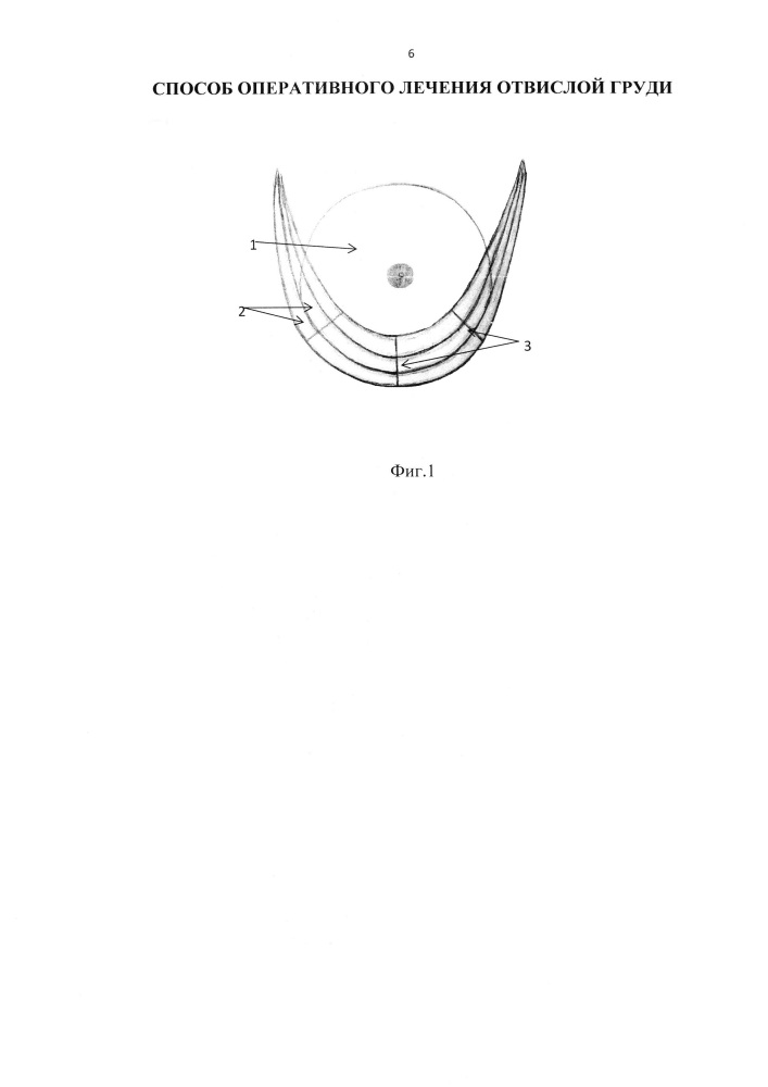 Способ оперативного лечения отвислой груди (патент 2644288)