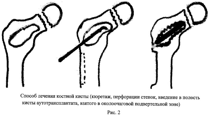 Способ лечения кистозной деструкции кости (патент 2456950)