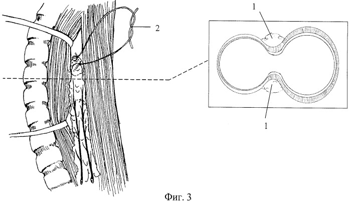 Способ хирургического лечения трахеопищеводных свищей неопухолевого генеза (патент 2421161)