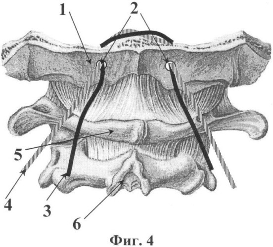 Способ фиксации шейно-затылочной области позвоночника (патент 2342915)