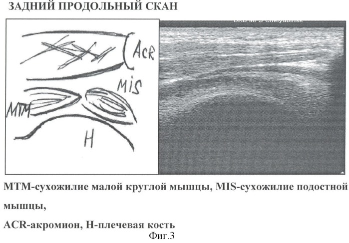 Способ ультразвуковой диагностики типа положения акромиального отростка лопатки относительно головки плечевой кости (патент 2367346)