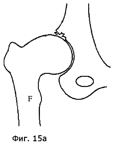 Устройство и способ для лечения бедренно-вертлужного соударения (патент 2506928)
