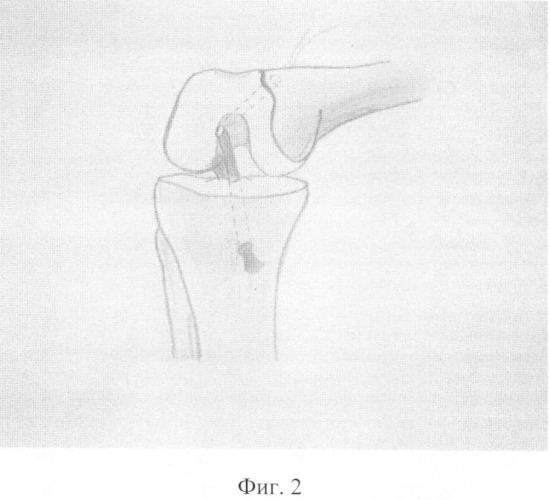 Способ артроскопической реконструкции частично поврежденной передней крестообразной связки коленного сустава (патент 2370231)