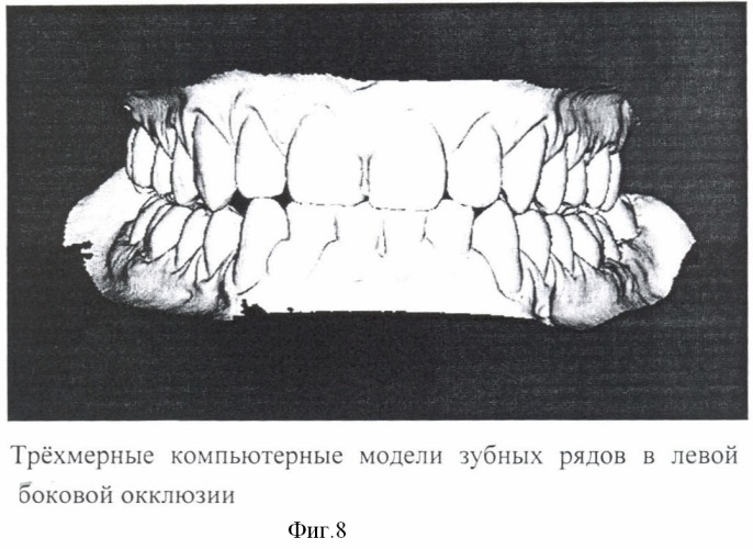 Способ воспроизведения зарегистрированных окклюзионных положений на компьютерных трехмерных моделях зубных рядов и ориентации компьютерных трехмерных моделей в пространстве (патент 2401083)