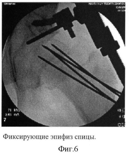 Способ лечения юношеского эпифизиолиза головки бедренной кости у детей (патент 2422110)