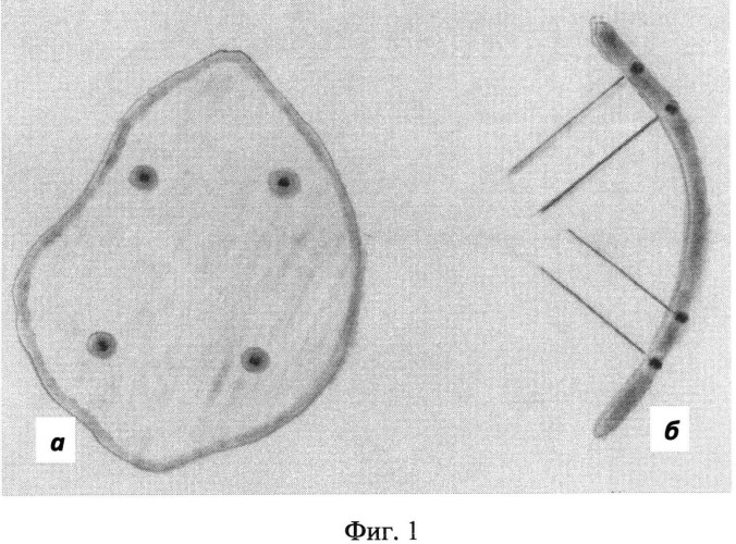 Способ имплантации хрящевой пластинки (патент 2506916)