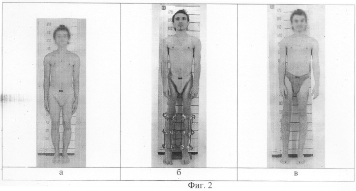 Способ увеличения продольных размеров конечностей (патент 2305510)