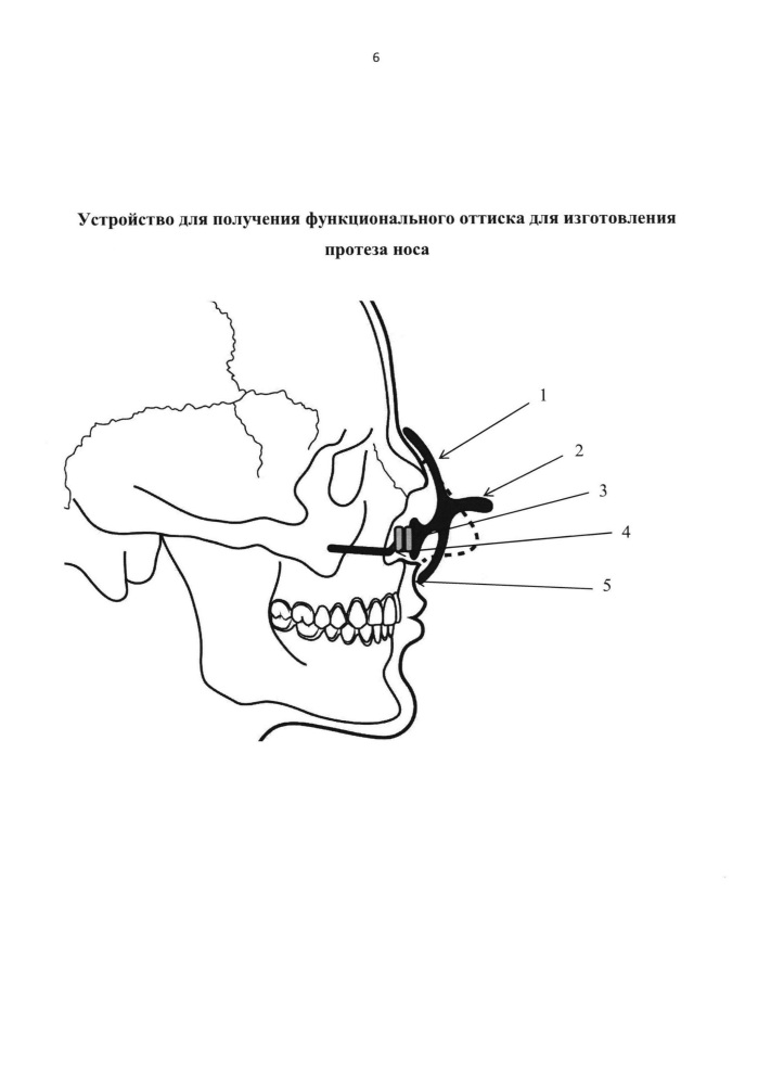 Устройство для получения функционального оттиска для изготовления протеза носа (патент 2625645)