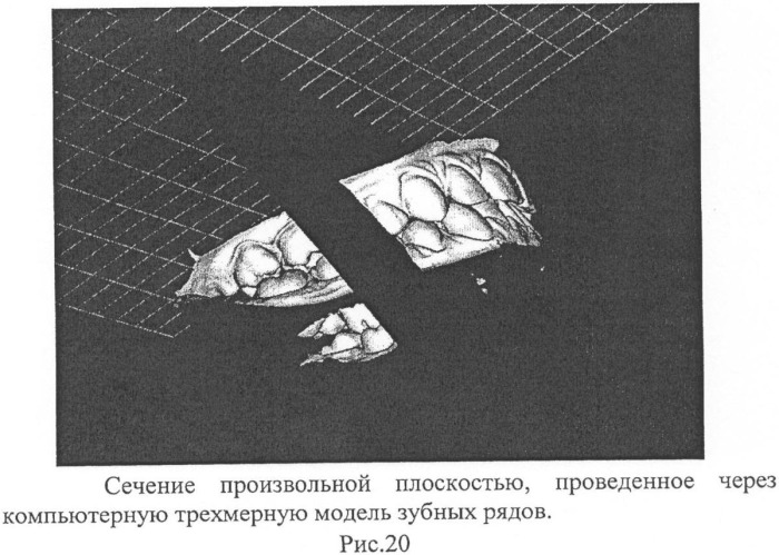 Способ контроля препарирования окклюзионной поверхности зубов при ортопедическом лечении несъемными протезами (патент 2396921)