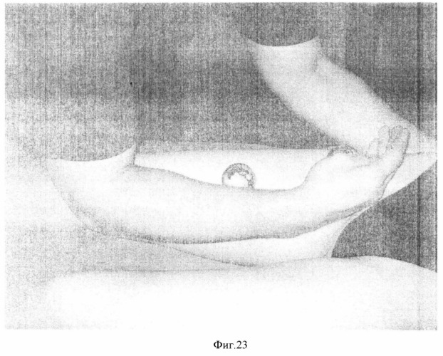 Способ моделирования фигуры при консервативном лечении ожирения (патент 2364387)