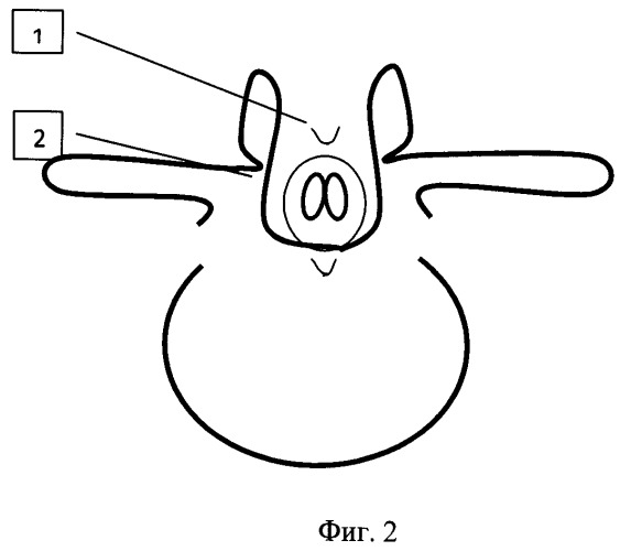 Способ формирования задней стенки позвоночного канала при спинальной дизрафии (патент 2497472)