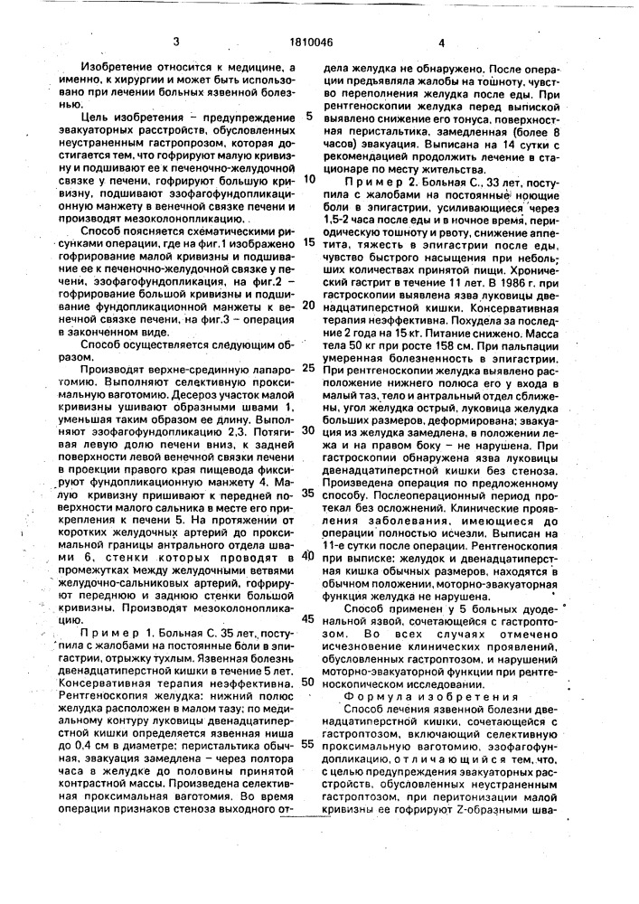 Способ лечения язвенной болезни двенадцатиперстной кишки, сочетающейся с гастроптозом (патент 1810046)
