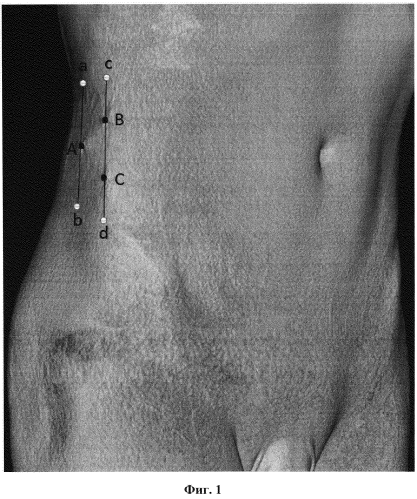 Способ лечения артериальной ишемии нижних конечностей при дистальном типе поражения методом лапароскопической ретроперитонеальной поясничной симпатэктомии (патент 2576794)