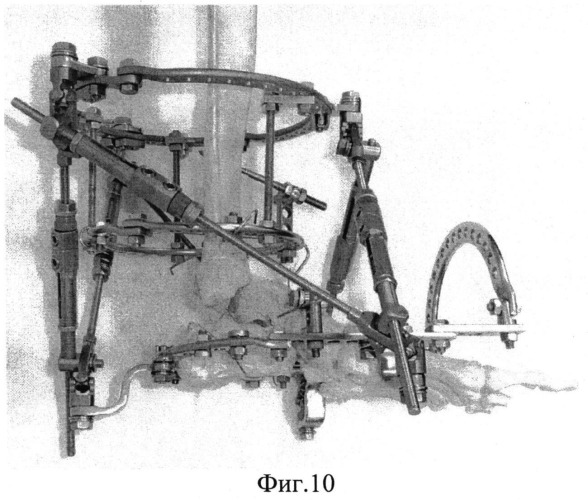 Способ остеосинтеза аппаратом орто-сув для устранения вывихов в голеностопном суставе (патент 2547798)