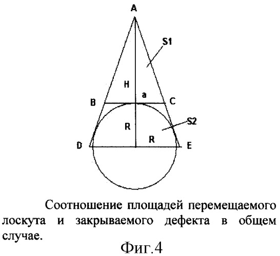 Способ сочетанного закрытия дефекта кожи местными тканями и свободными кожными лоскутами (патент 2326609)