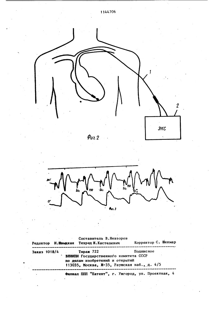 Способ урежающей электрической стимуляции сердца (патент 1144706)