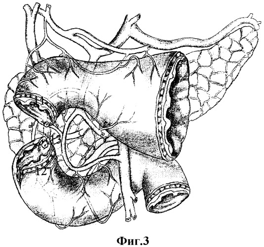 Способ хирургического лечения осложненных низких дуоденальных язв с поражением большого и малого дуоденальных сосочков (патент 2312609)