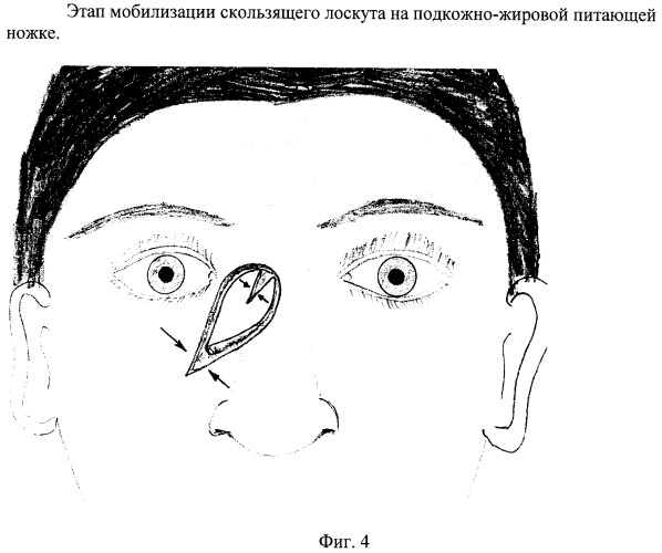 Способ пластики корня носа и медиального угла глаза (патент 2375000)