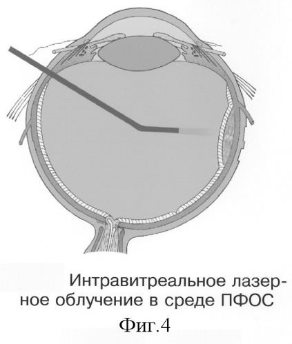 Способ электрохимической деструкции, хирургического удаления и фотодинамической профилактики рецидивов внутриглазных новообразований в среде перфторорганического соединения (варианты) (патент 2244533)