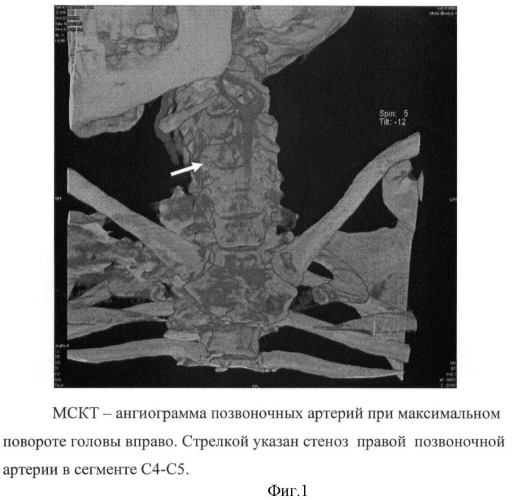 Способ позиционной мультиспиральной кт-ангиографии в экспертной оценке состояния позвоночных артерий у больных с дорсопатией шейного отдела позвоночника и с синдромом недостаточности кровообращения в вертебро-базилярной системе (патент 2398503)