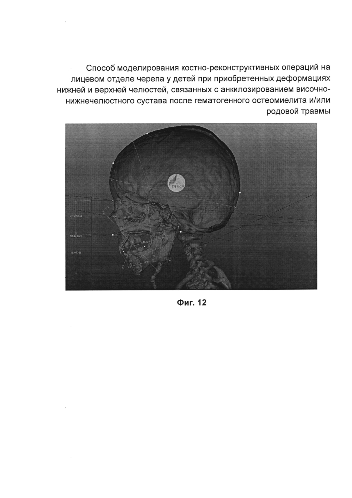 Способ моделирования костно-реконструктивных операций на лицевом отделе черепа у детей при приобретенных деформациях нижней и верхней челюстей, связанных с анкилозированием височно-нижнечелюстного сустава после гематогенного остеомиелита и/или родовой травмы (патент 2604774)