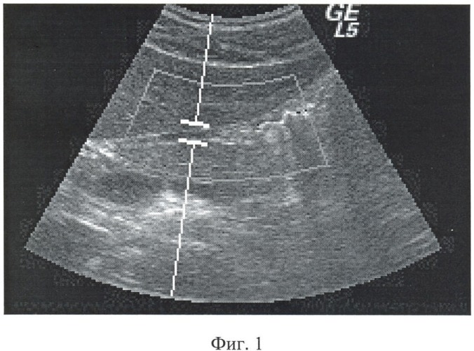 Способ дуплексного сканирования левой желудочной артерии (патент 2393770)