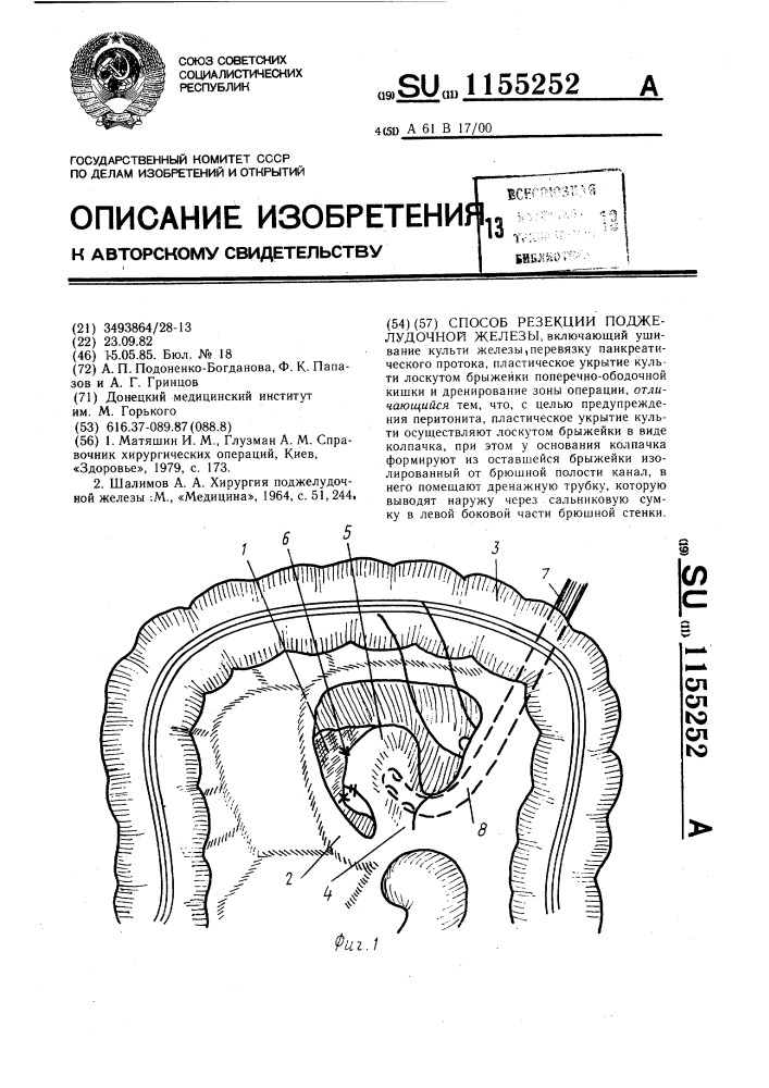 Способ резекции поджелудочной железы (патент 1155252)