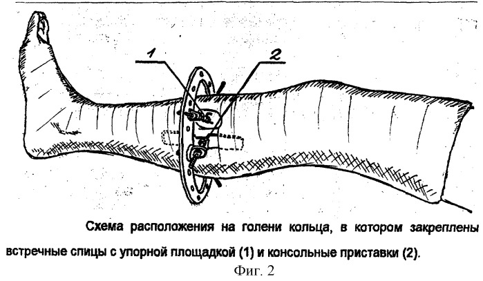 Способ обеспечения взаимной компрессии костных отломков при лечении косых переломов большеберцовой кости (патент 2249436)