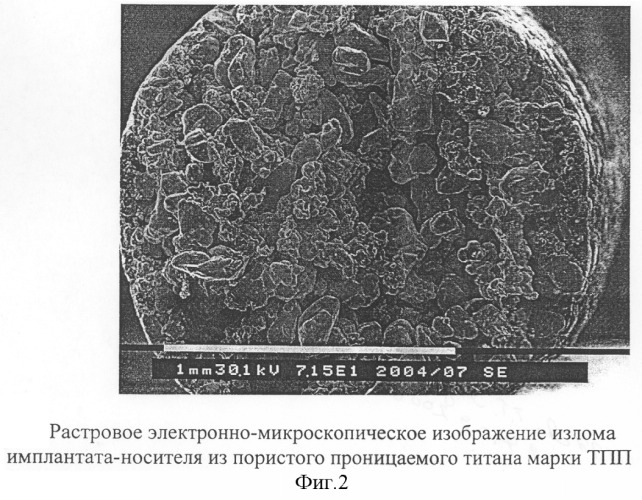 Имплантат-носитель для хирургического лечения заболеваний внутренних органов (патент 2300345)